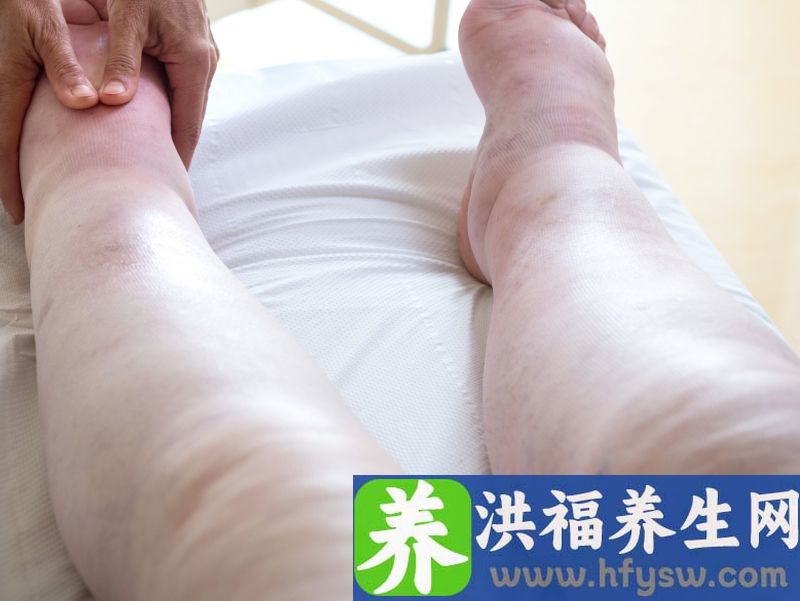 营养不良性水肿的诊断