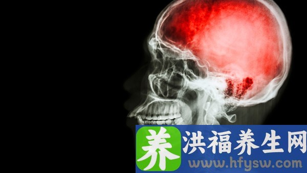 小脑萎缩是老年痴呆症吗
