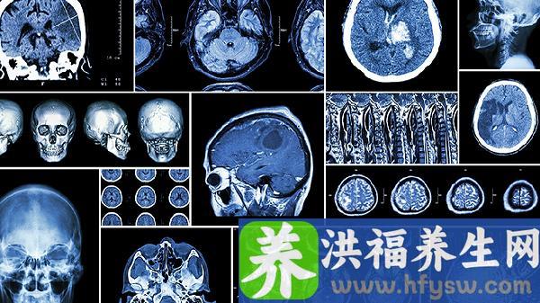 得了脑溢血有什么后遗症