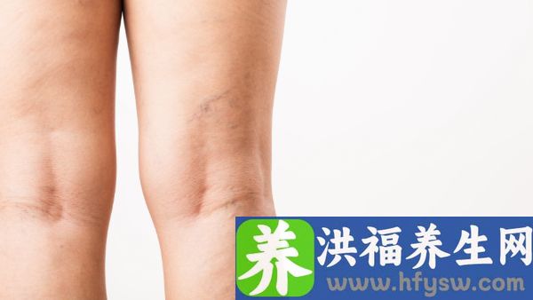 站时间长了腿胀怎么办