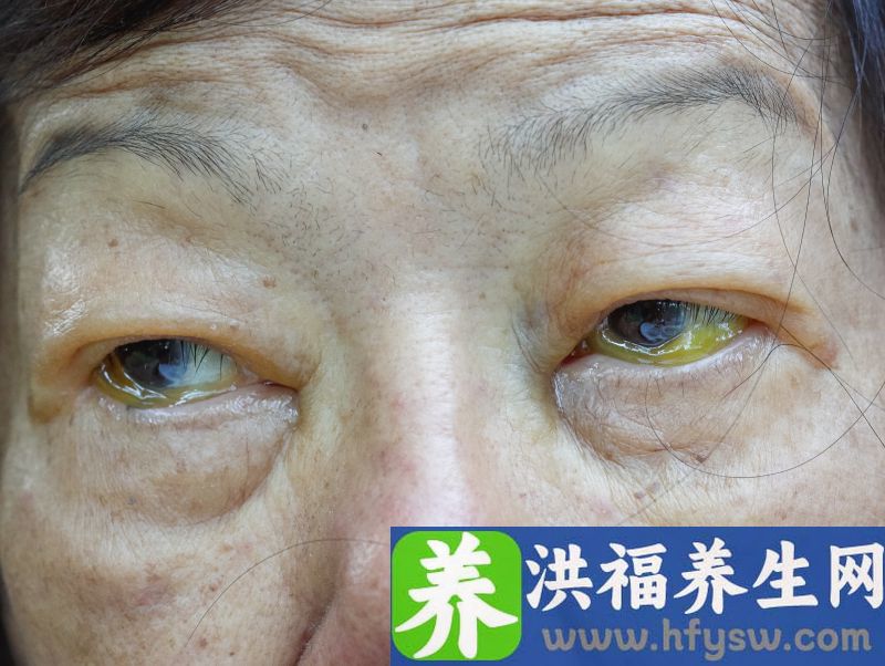 为什么中老年人容易长老年斑？涂抹牙膏和生姜能去除吗？告诉你