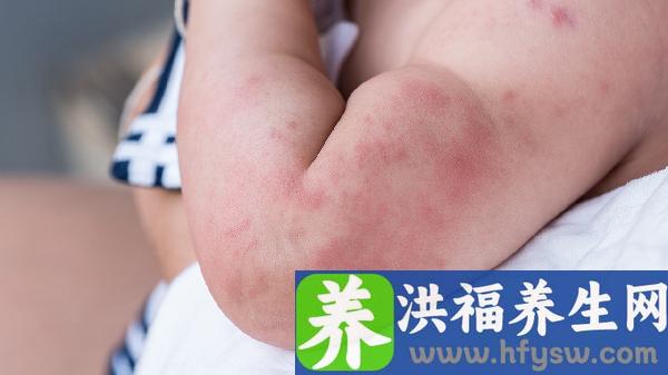 春季荨麻疹五大过敏原揭秘！这些简单措施帮你轻松应对