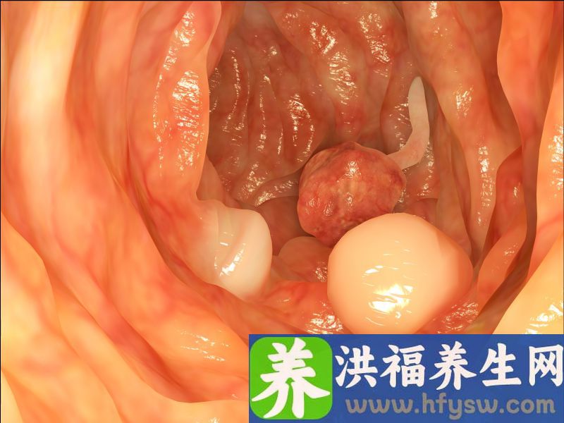 大肠息肉与年龄有关系？这4大诱因不能忽视，做好预防工作