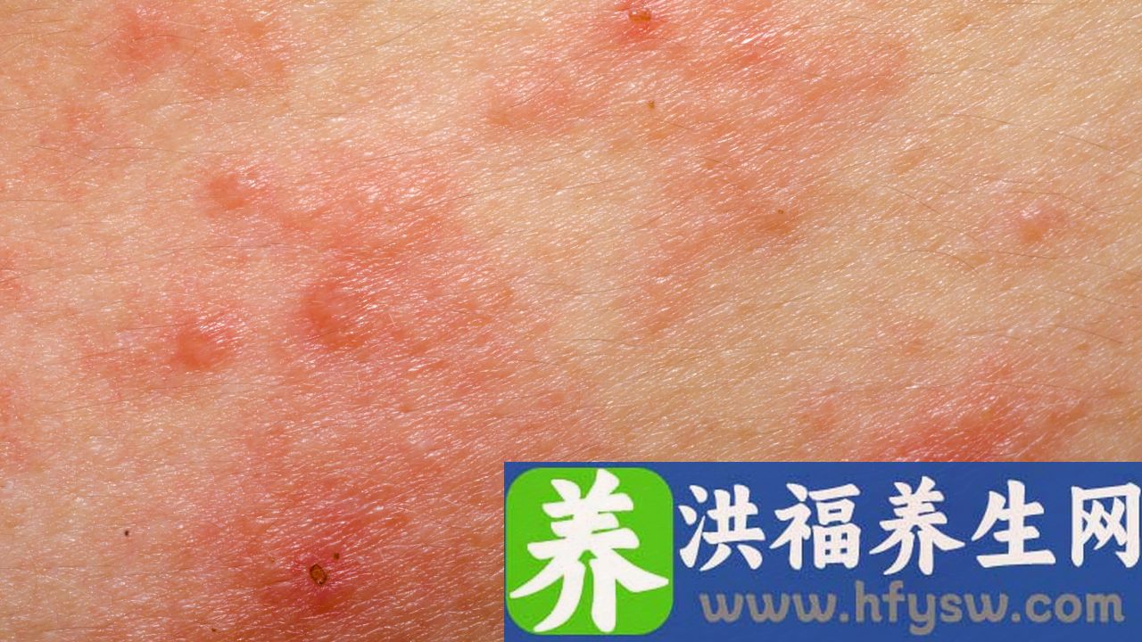 皮肌炎是什么病，严重吗
