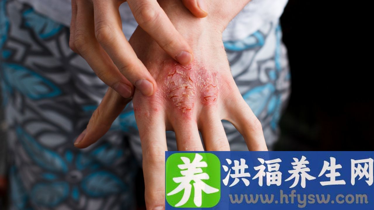 结节性红斑是什么原因引起的