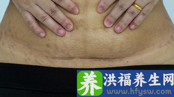 剖腹产影响伤口愈合的食物