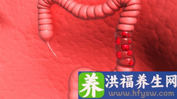 溃疡性结肠炎便血吃什么药止血
