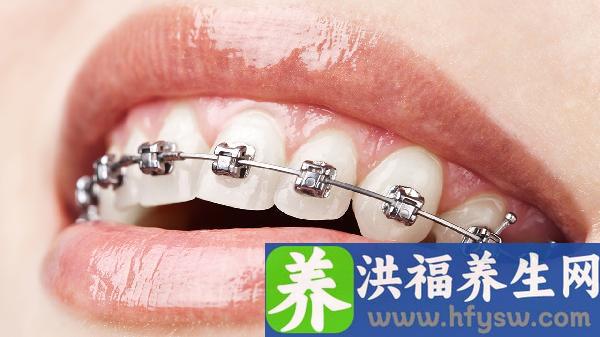 美容冠牙齿矫正需要多少时间