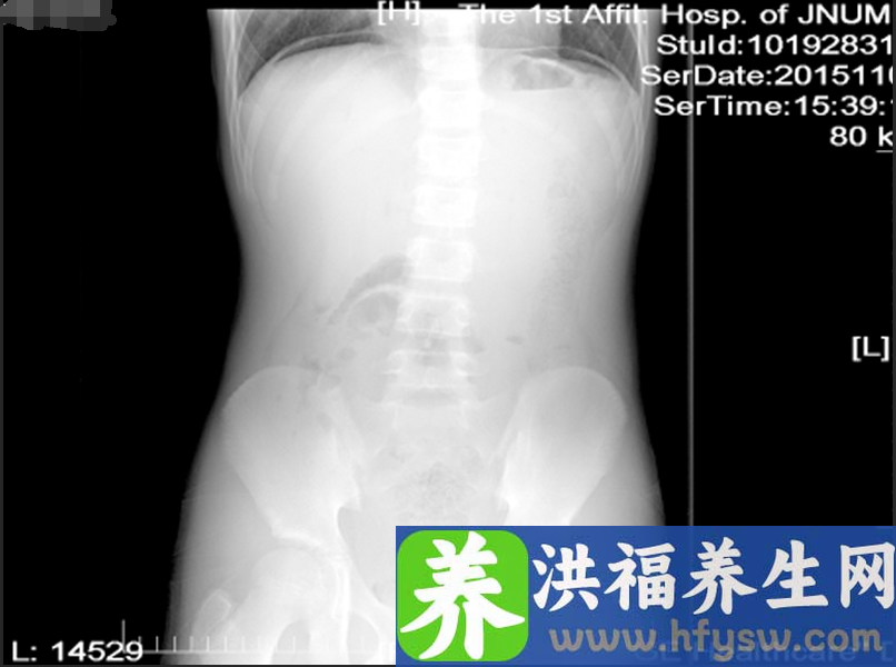 15岁学生胃穿孔，腹腔镜修补术恢复好