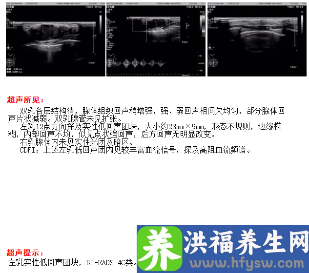 82岁老年女性患导管原位癌，手术切除后恢复健康