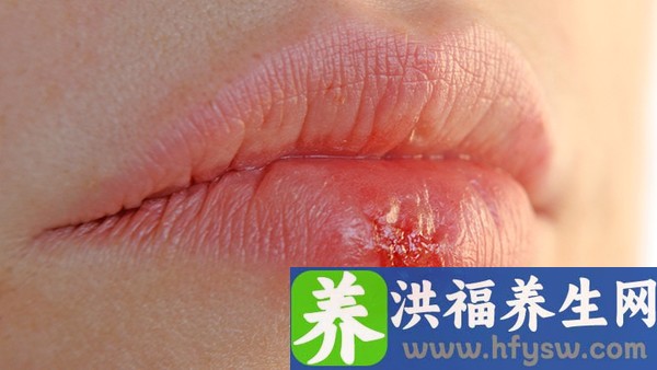 女性生殖器疱疹的几个症状 女性生殖器疱疹症状都有什么