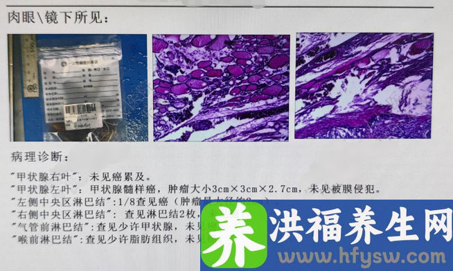 中年女性颈椎疼痛，竟然是甲状腺髓样癌在作祟