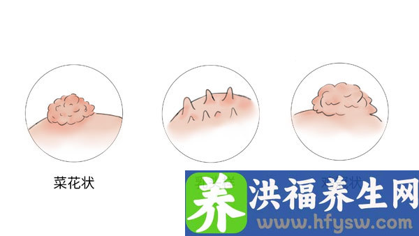 尖锐湿疣会威胁生命吗