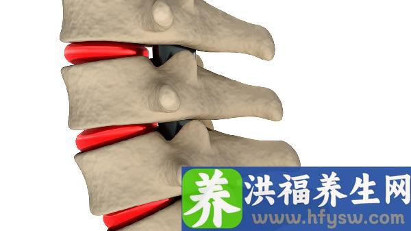 治颈椎骨质增生治疗的方法
