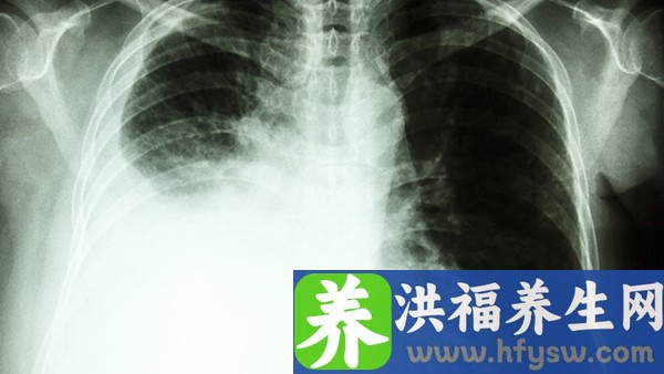 肺炎支原体感染1.35严重吗