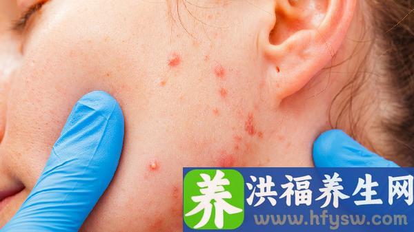 过敏性紫癜多久可以恢复正常运动健身