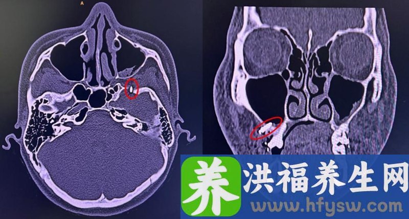 “矫牙”时钉子滑脱到颅底，医生导航定位精准取出