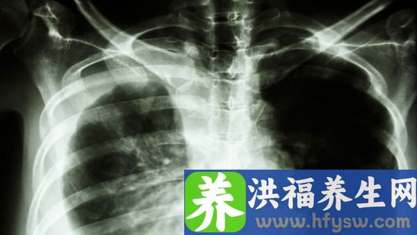 肺水肿有哪些症状