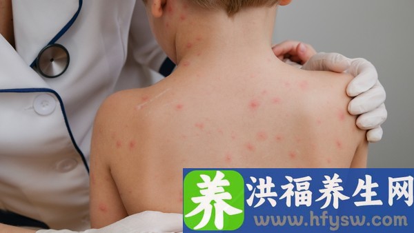 清肝解毒片是抗病毒的药吗 清肝毒的中成药有哪些