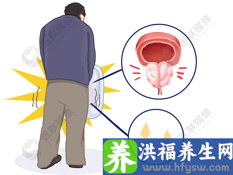 局部前列腺癌通常无症状，这些人群建议每年做前列腺癌筛查