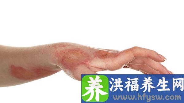 肺脓肿有空洞一般治疗多久能运动好转