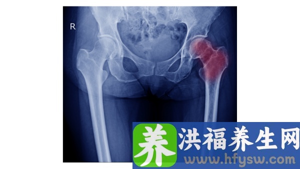 股骨头病是怎么得的