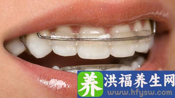 自锁托槽牙齿矫正费用是多少