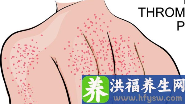 荨麻疹吃什么药最有效 防参止痒颗粒能和感冒灵颗粒一起吃吗