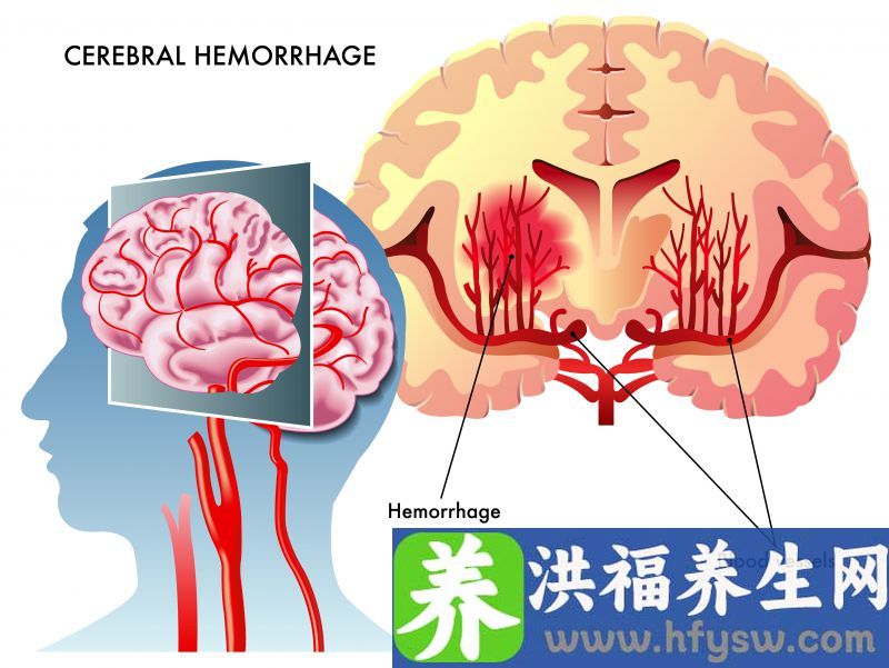 高血压患者家属注意，遇到突发脑溢血，做好4件事，或能救人