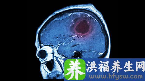 脑栓塞临床特征主要是