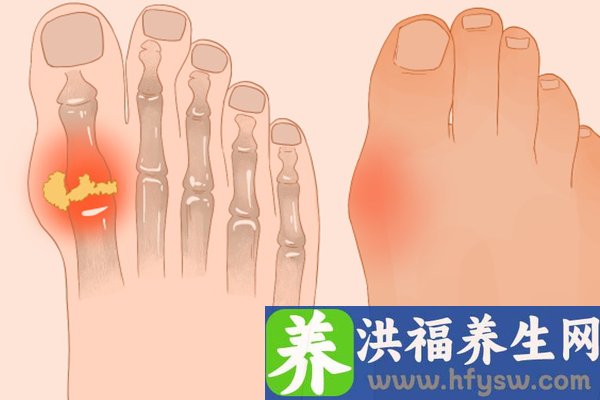 痛风可以吃草莓吗