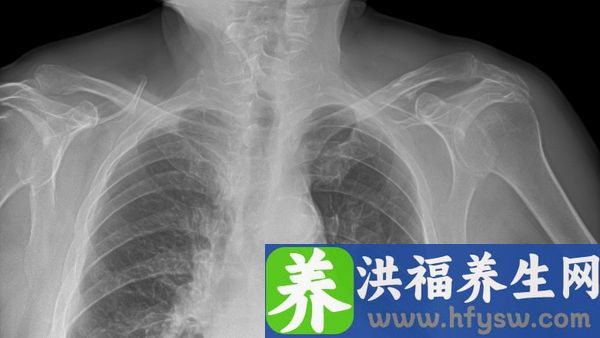 肺气肿患者的临床症状