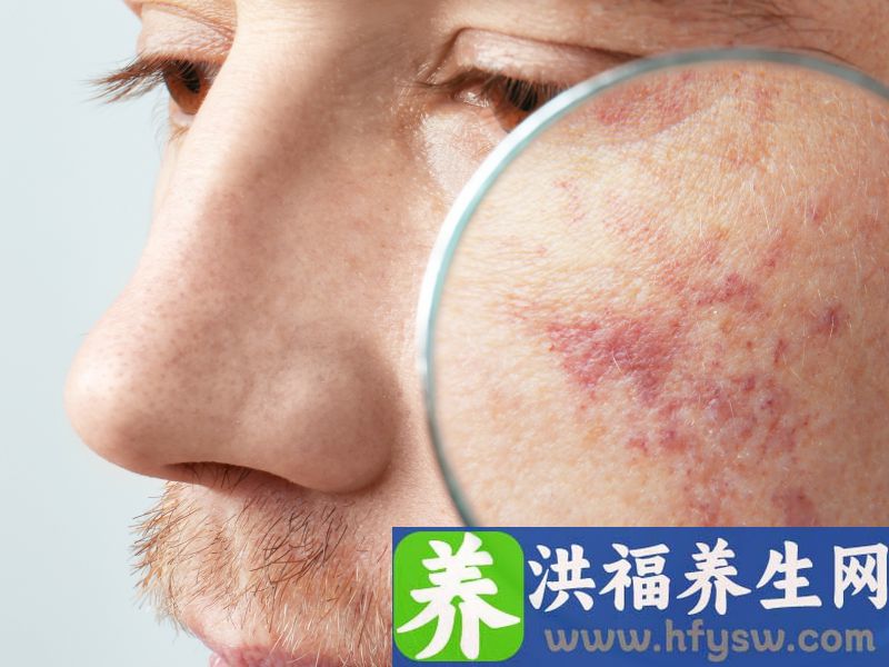 红胎记的给人的影响和危害