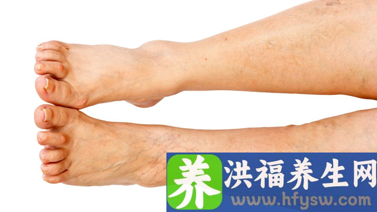 下肢血液循环不好症状表现有哪些