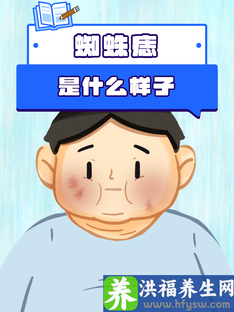 蜘蛛痣是什么样子？一文特征揭秘
