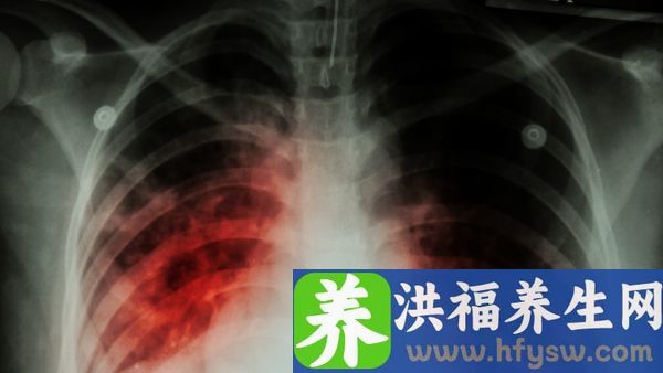 哪种肺结核不需要治疗