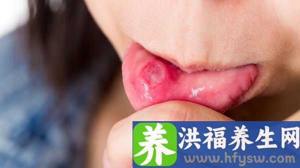口腔溃疡疼痛难忍怎么治疗？漱口水治疗口腔溃疡的效果如何