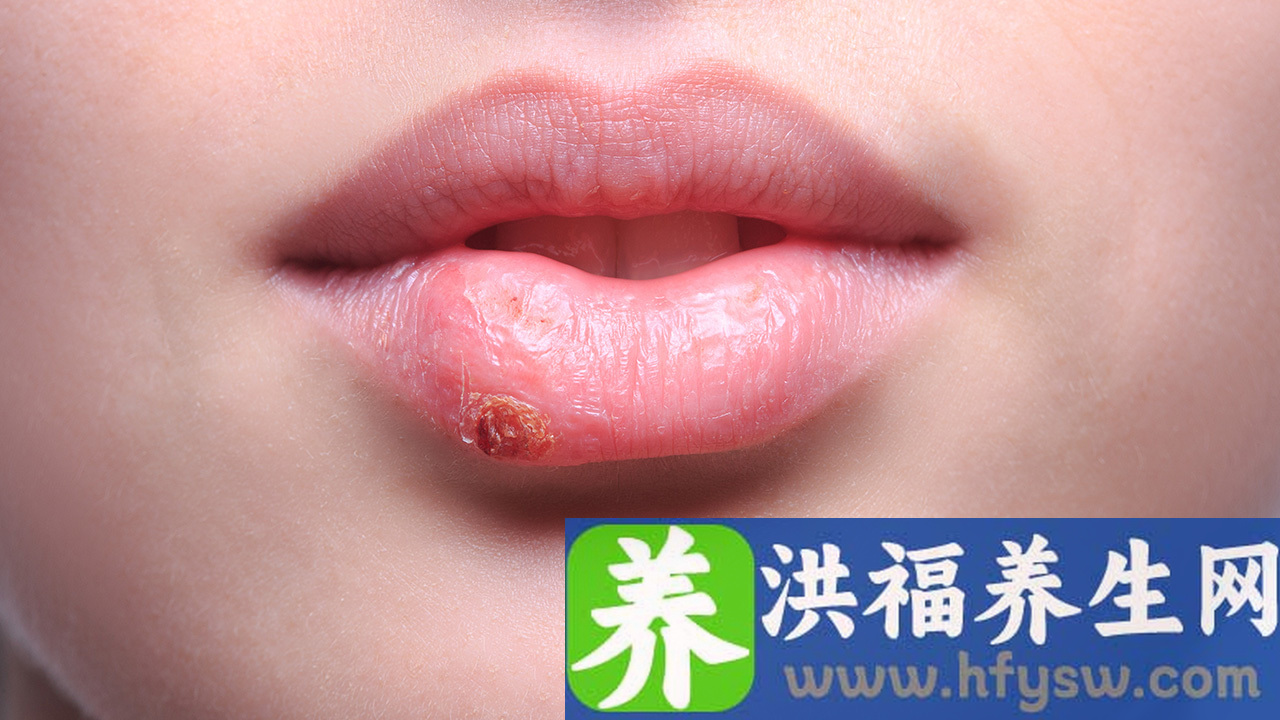 揭示生殖器疱疹的症状表现 生殖器疱疹会出现哪些症状