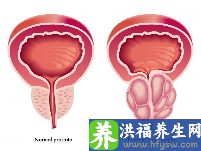 男性朋友注意了，引起前列腺肥大的4大原因，看看你中了几个