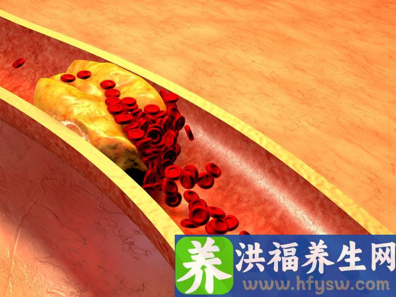 “甘油三酯”高于这个数，离心梗脑梗又近一步！建议立即服药干预