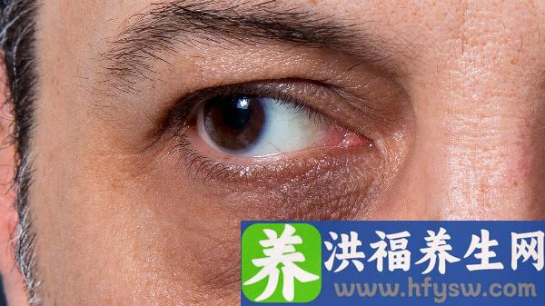 胶原蛋白填充祛黑眼圈麻醉方式是什么？