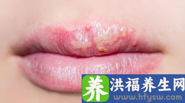 女性大腿内侧疱疹的原因是什么？