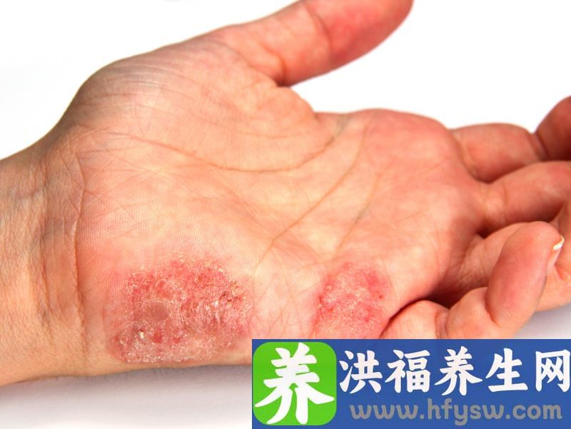 百草枯中毒的保健护理