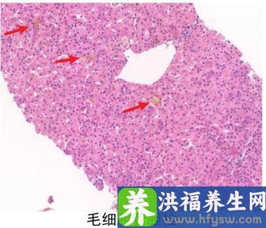 胆汁淤积致全身黄染，专家层层排查确诊病情