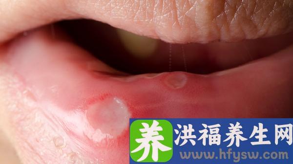 嘴巴上火起泡怎么快速消除 如何鉴别上火和疱疹