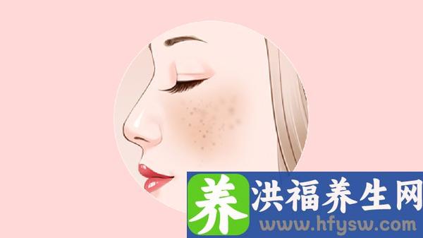 激光祛斑前的三个安全须知