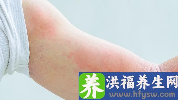 汗疱疹导致指甲受损能恢复吗