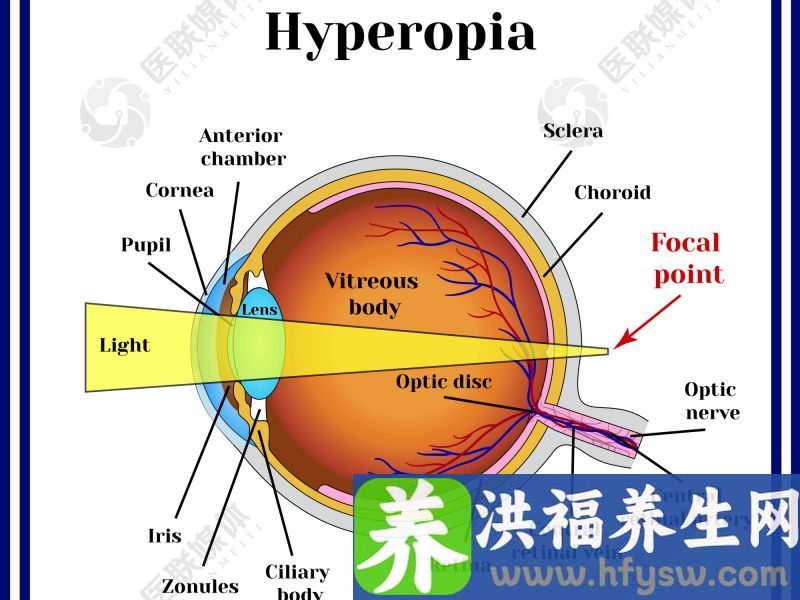 远视眼有“救”了 飞秒激光精准矫正600度远视