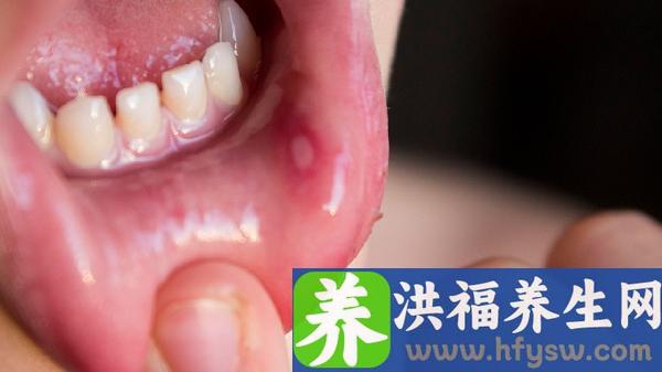 牙龈上火吃什么食物可以降火快