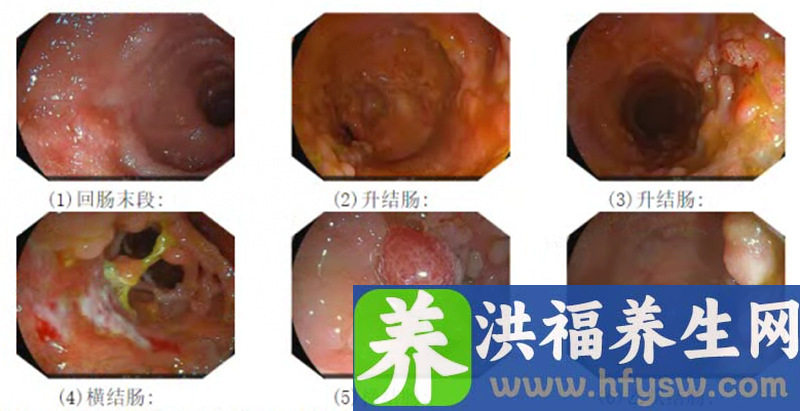 小切口，大手术！逸仙胃肠外科团队成功实施腹腔镜下全结肠切除术！